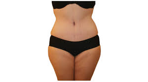 Get The Best Liposuction Results With These Proven Techniques