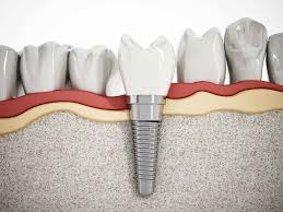 Ultimate Dental Implant Guide: Tips For Success