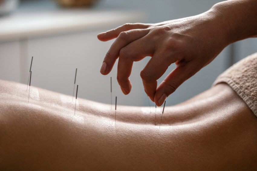 Acupuncture Therapy Guide: Benefits And Techniques